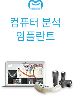 컴퓨터 분석 임플란트 안내 모형 이미지