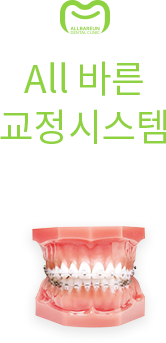 올바른 교정시스템 — 교정 장치를 부착한 치아 모형